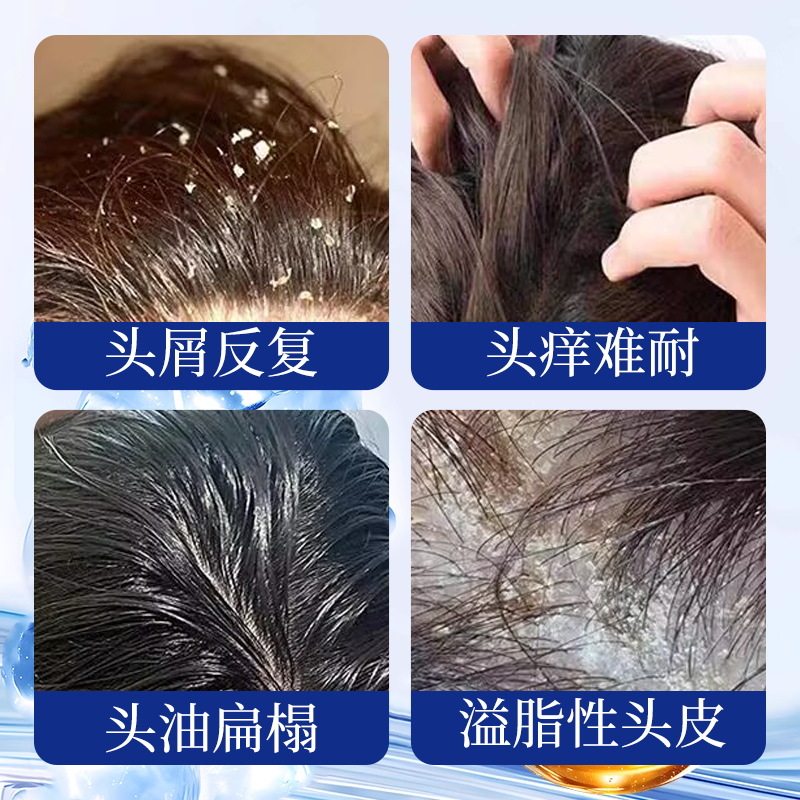Tuotian Pharmaceutical Hair Follicle Cleansing Shampoo Removes Acne, Removes Mites, and Controls Oil. Shampoo Is Suitable for Both Men and Women
