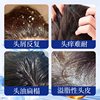 Tuotian Pharmaceutical Hair Follicle Cleansing Shampoo Removes Acne, Removes Mites, and Controls Oil. Shampoo Is Suitable for Both Men and Women