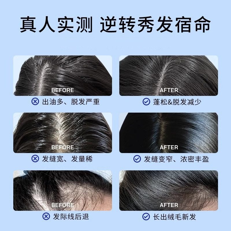 Ehd Anti-Hair Loss Shampoo, Oil Control, Fluffy, Smooth, Anti-Breakage, Refreshing and Clean Head Oil Shampoo, Men's and Women's Shampoo