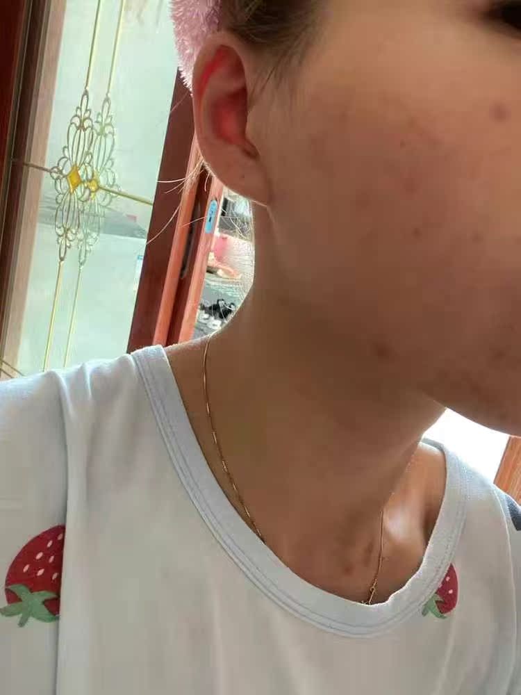 最新揭秘博乐达水杨酸面膜贴片面膜真实感受曝光?真实体验曝光