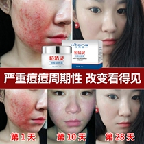 How to remove acne and acne cream on mens and womens official website to treat Bean face acne