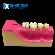 Dental lower right posterior tooth tissue decomposition model Dental anatomy Oral teaching Removable tooth model