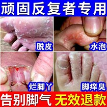 Athletes foot relieves itching itchy feet blisters peeling rotten feet