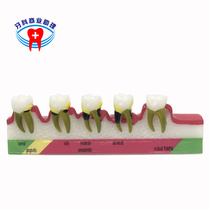 Dental materials Caries development decomposition Periodontal disease classification model Doctor-patient communication explanation Qinggen