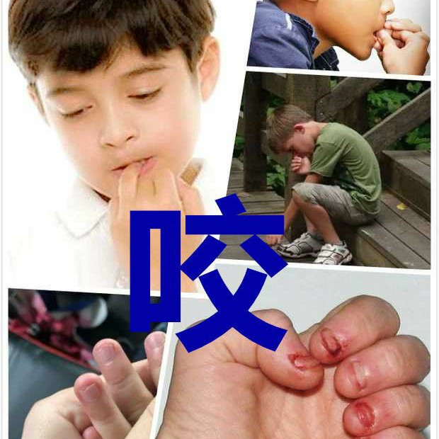 学生吃手咬甲矫正用品