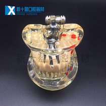 Dental Material Oral Model Adult Pathology Crystal Model Half - side Tooth Pathopathology