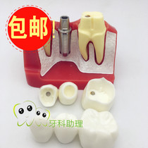 Dental four 4x implant explanation model with implant nail Doctor-patient communication with bridge crown porcelain repair model
