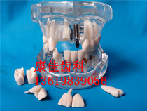 Dental Material Activity Model Pathological Model Crystal Explanation Communication Teaching Accessories