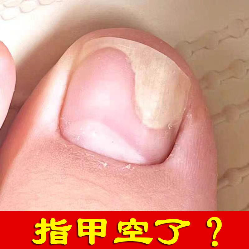 Nail Treatment Solution for Repairing Damaged Nails, Regenerating Nail Beds, Separating Nail Tissue, and Dealing with Thin Nails, with Specialized Layer-By-Layer Nourishment for Growth of Fingernails and Toenails Nail Treatment Solution for Repairing Damaged Nails, Regenerating Nail Beds, Separating Nail Tissue, and Dealing with Thin Nails, with Specialized Layer-By-Layer Nourishment for Growth of Fingernails and Toenails