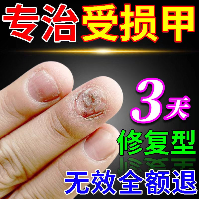 Nail Bed Repair Solution for Damaged, Regenerating, Empty Nail Beds, Separation, Atrophy, Growth Solution, Chewing, Cracking, Uneven Surface Nail Bed Repair Solution for Damaged, Regenerating, Empty Nail Beds, Separation, Atrophy, Growth Solution, Chewing, Cracking, Uneven Surface