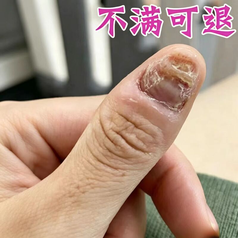 Treatment Solution for Uneven Nail Caps, Softening of Nail Plates, Damage, Splitting, Fungal Infection, Yellow Thickening, and Layering of Nails Treatment Solution for Uneven Nail Caps, Softening of Nail Plates, Damage, Splitting, Fungal Infection, Yellow Thickening, and Layering of Nails