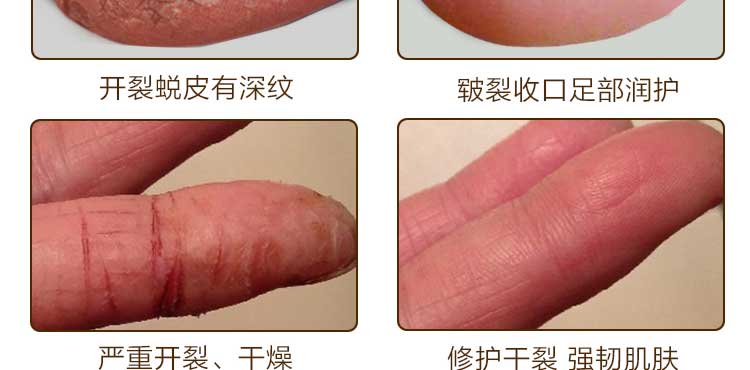 Mỡ ngựa, gót chân, nứt, chống nứt, nứt, nứt, tay, chân, chống nứt, bong tróc, chăm sóc chân, kem bôi tay kem ủ chà gót chân