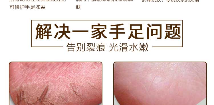 Mỡ ngựa, gót chân, nứt, chống nứt, nứt, nứt, tay, chân, chống nứt, bong tróc, chăm sóc chân, kem bôi tay kem trị nứt gót chân