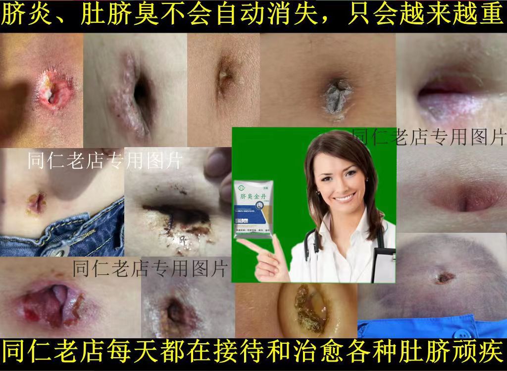 Belly button Inflammation Itch to Skin Pussy Black Dirty Red With Secretions Stink Smell Wet Stick Clean not Clean-Taobao