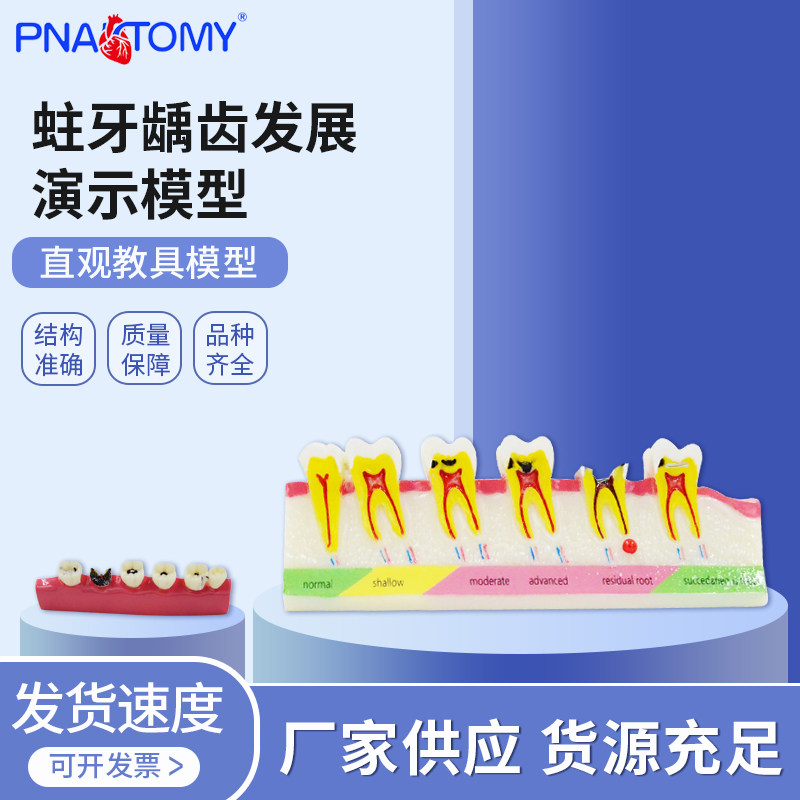 医学教学蛀牙龋齿演变解剖模型釉质牙本质龋坏牙髓感染龋洞口腔科