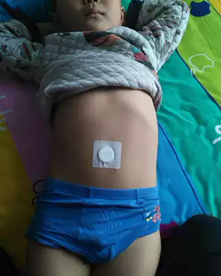 Child Jianpi Xiaoqi Accumulation, constipation, abdominal distension, diarrhea, anorexia, navel stickers