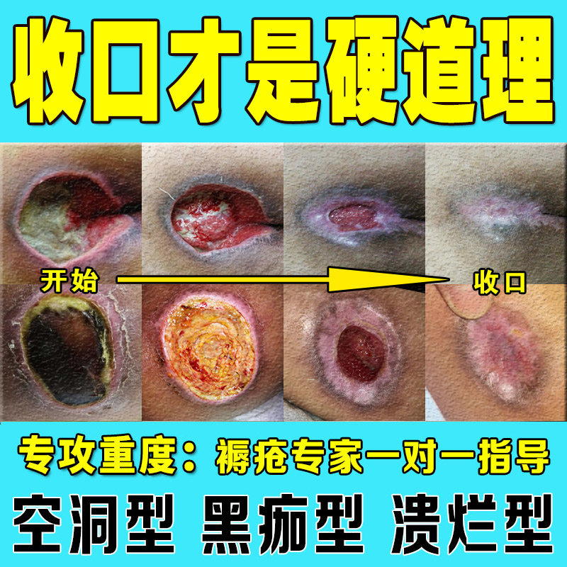 Pressure sore patch wound healing agent combined with old rotten leg old man dressing buttocks external use of anti-pressure ulcer paste new muscle ointment