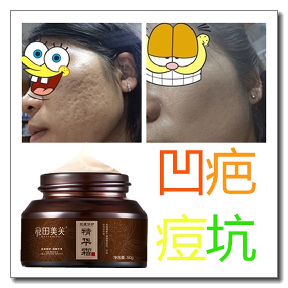 Paste depressions Acne Scarring Cream Bean Print Pimple Pit Regeneration Youthful Pimple Acne Shrink pores Men and women General