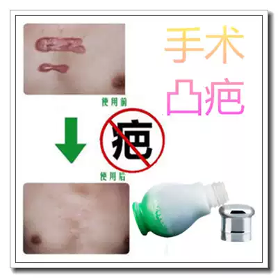 Remove scratches, melanin marks, Scar, cold compress gel, acne, remove acne marks, face old wounds, scar spirit cream products