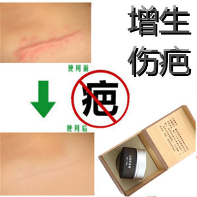 Anti-proliferative Convex Scar print removal Surgery post-surgery Caesarean section Knife Injury Softening of the Lump Repair Fluid Tumble Essence Cream