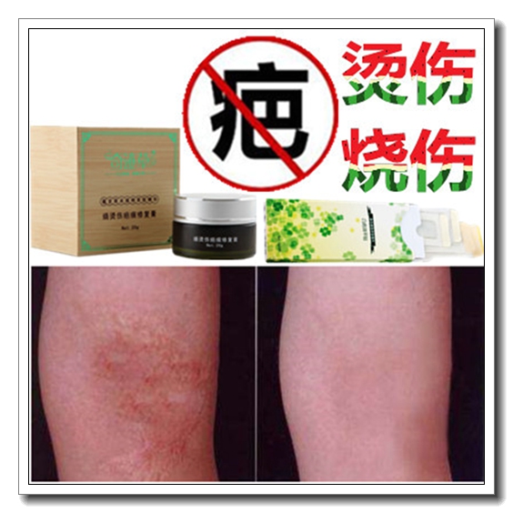 Remove the baby scalping scarring powerful flawless cream to remove the face colour spot black pigment burn bab to cover the deity