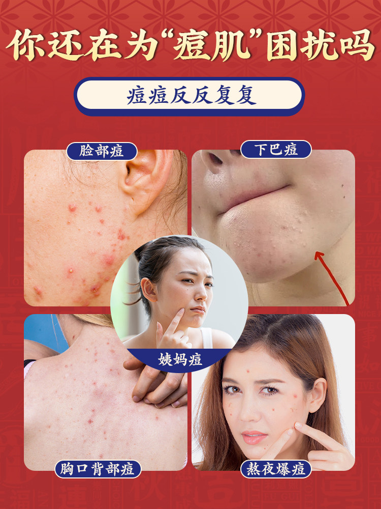 Acne-Removing Internal Tablets to Regulate Female Endocrine Disorders, Tea for Chin Acne, Men's Non-Detoxifying Beauty and Regulation