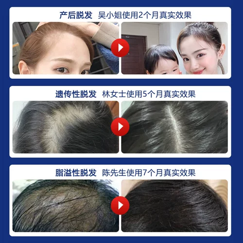 Доктор Мяо Цзянь, Шангуань, развивается, развивает шампунь, стреляющие волосы, волосы, волосы, лысые волосы, раствор роста волос волос на волосах