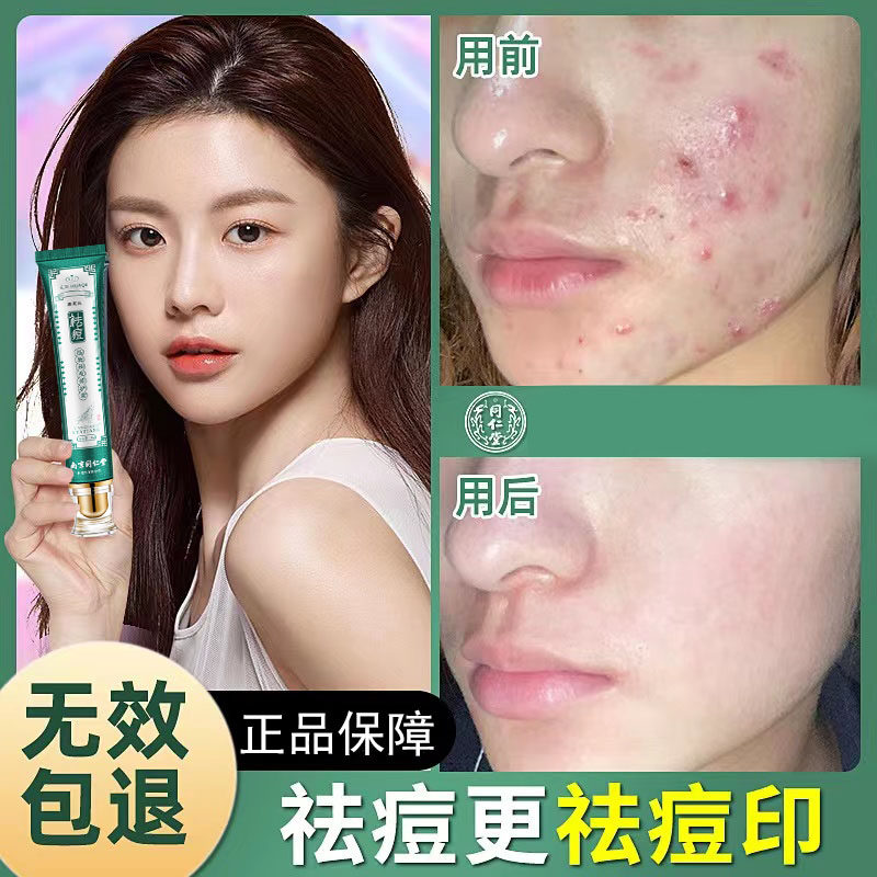 Tongrentang acne cream lightens acne marks, removes acne, closes mouth redness, acne cream, repairs skin, men and women only - Taobao