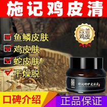 Shi Kee Chicken Skin Repair Body Lotion to remove goose pimples hair follicles keratinized fish scales Shi Kee Chicken Skin Repair