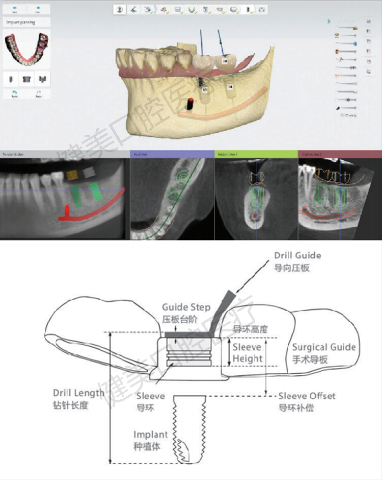 3Shape Exocad planting guide ring guide ring catheter can be customized