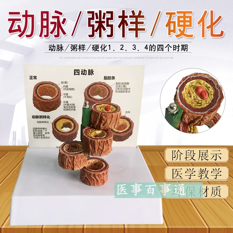 动脉11化模型带血栓模型 血管模型 形成过程模型 人体粥样化