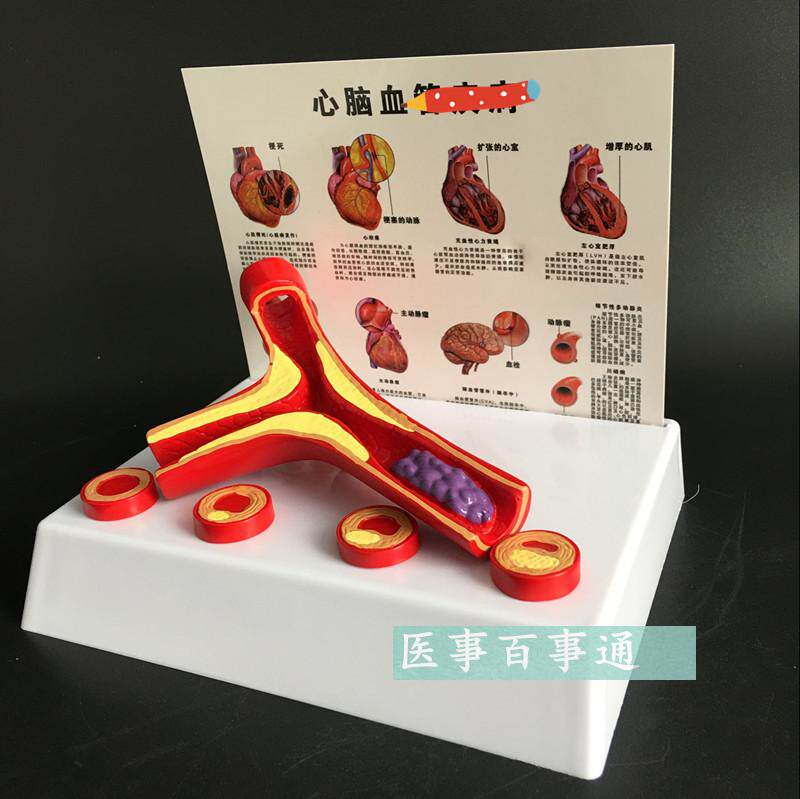 动脉模型硬化带血栓模型动脉血管粥样硬化带血栓病变器官内脏模型