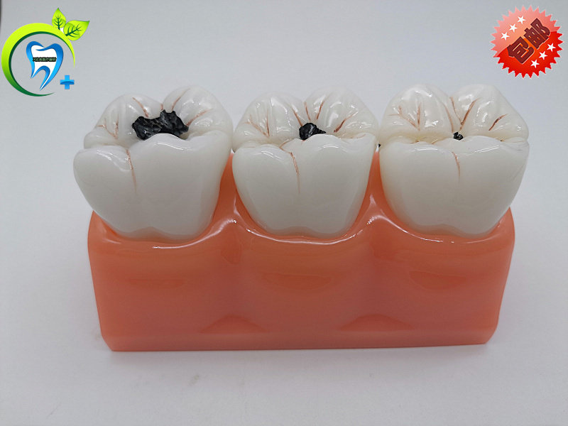 牙科口腔教学模型 4倍龋齿分解 龋坏展示坏牙病变  医患沟通 包邮