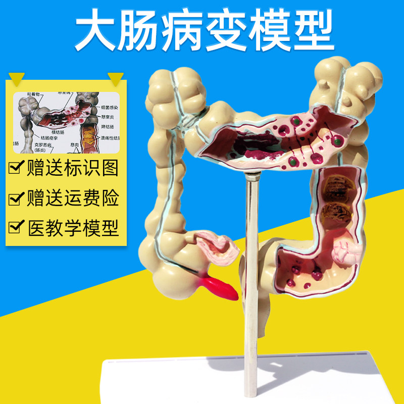 大肠病理模型 大肠模型 大肠病变模型 肠道疾病 人体结肠病变模型