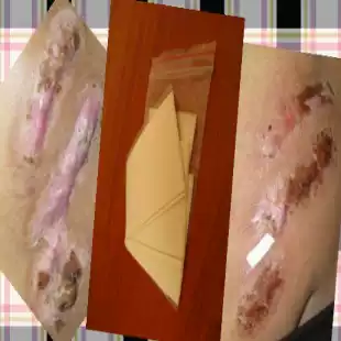 Scar pimple scar physique hyperplasia scar hyperplasia raised scar caesarean section ear hole hyperplasia scar