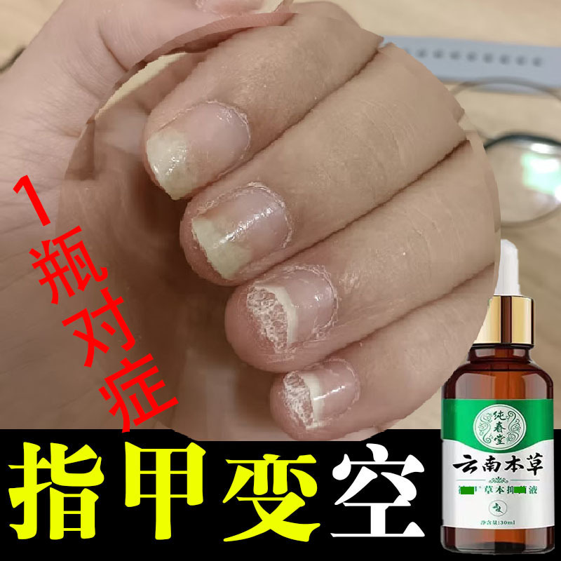 Nail Bed Becomes Hollow, Nail Flesh Separates, Repair Nutrient Solution, Nails Become Short, Uneven, and Damaged Due to Biting