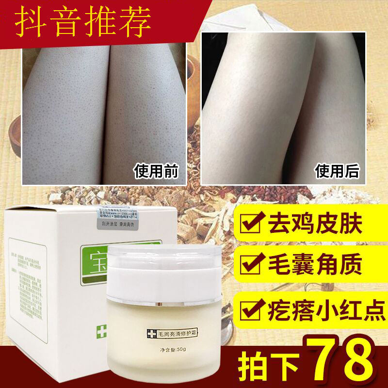 Helps remove chicken skin pimples, hair follicles, keratinization of the skin around the thighs, legs, whole body cream for women