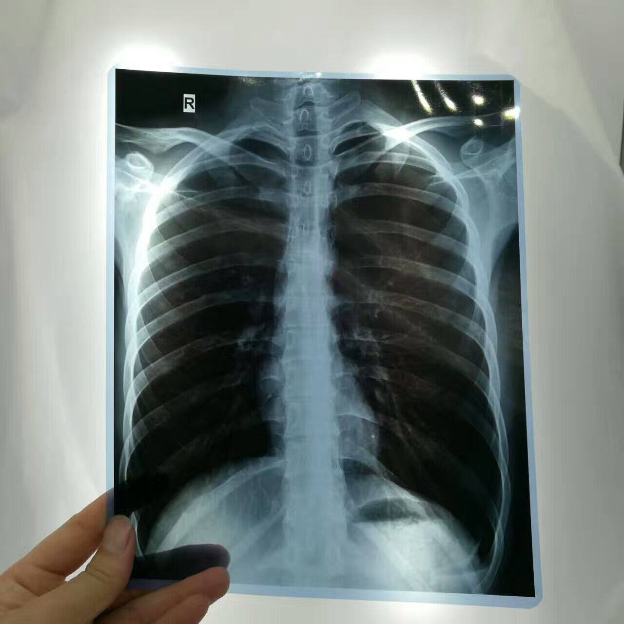 Medical negatives inkjet Blue sheet Dry swab CT DR CR Dental fracture X-ray Radiology Print negatives
