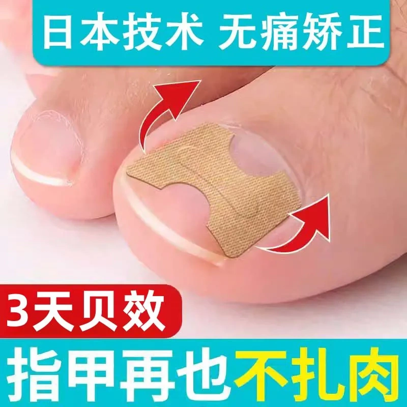 Ingrown Toenail Correction Tool, Ingrown Toenail Corrector, Big Toe Nail Correction Device, No Glue Needed, Nail Correction Patch