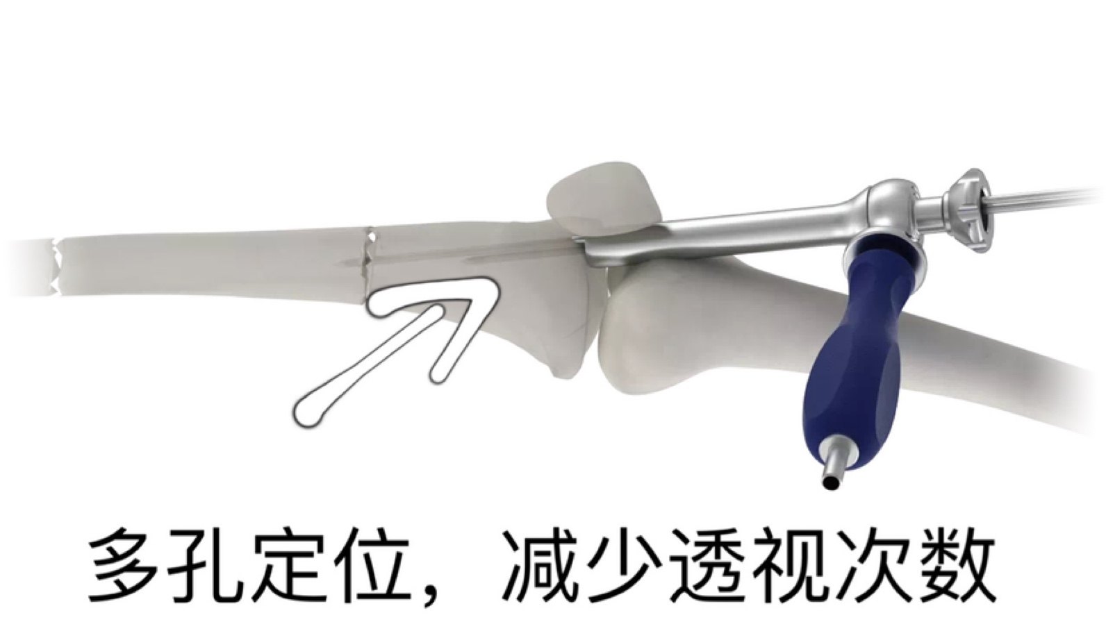 骨科器械 蜂窝导向器 医用PFNA多孔套筒 髓内钉螺纹导针定位包邮