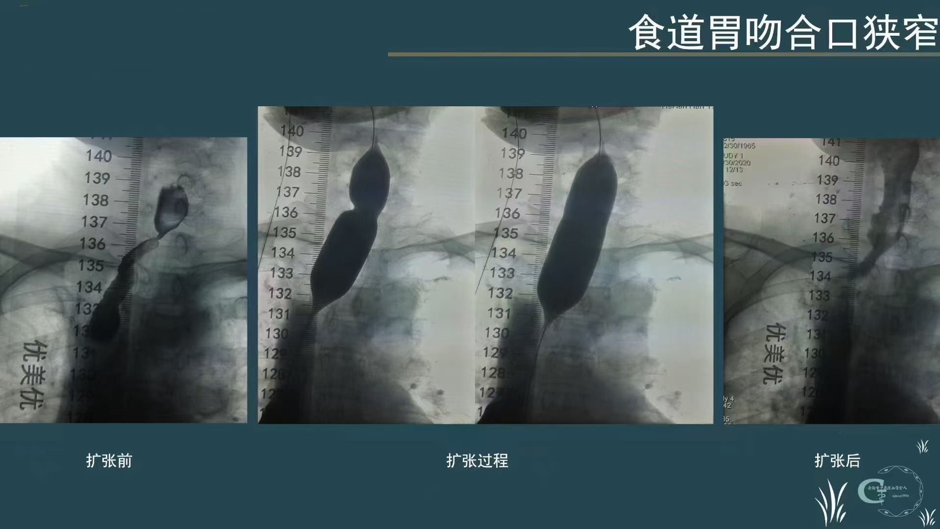 骨科软尺 脊柱软尺 脊柱显影尺 医用 X射线测量尺 透视显影尺