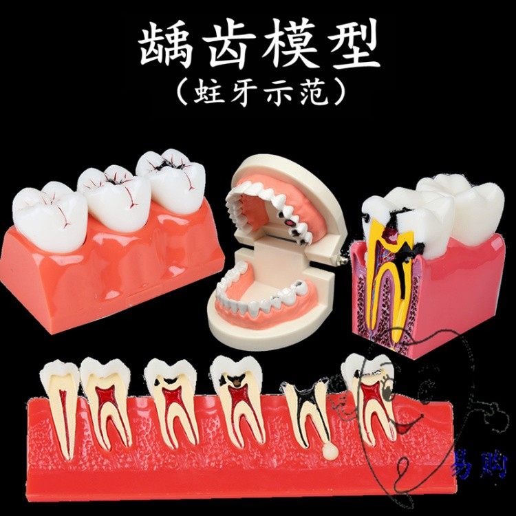 牙科 龋齿模型 幼儿蛀牙示范模型 龋坏牙齿分解 龋齿对比分类模型