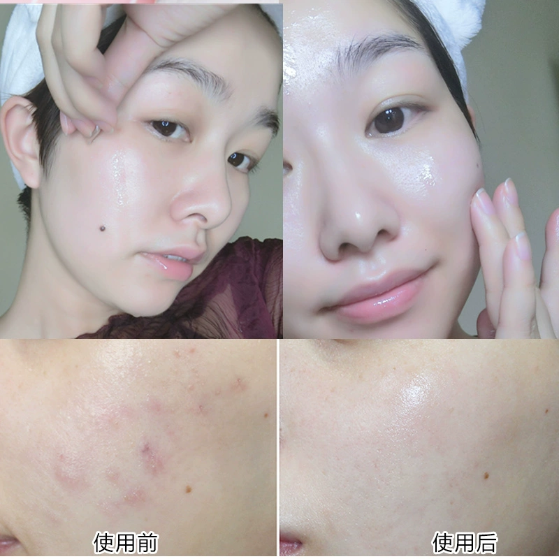 Tinh chất dưỡng da mặt đỏ ngứa Sửa chữa giữ ẩm Máu lụa đỏ serum hàn