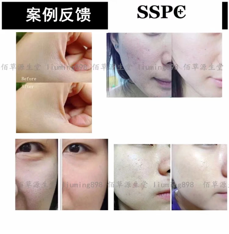 Tinh chất dưỡng da mặt đỏ ngứa Sửa chữa giữ ẩm Máu lụa đỏ serum hàn