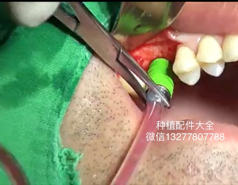 Ortodent Upper Maxillary Sinus Elevation Green Head Cas Tool Box Cas Flat Head Drill Stop Ring Green Water Pressure Head Ortodent Upper Maxillary Sinus Elevation Green Head Cas Tool Box Cas Flat Head Drill Stop Ring Green Water Pressure Head