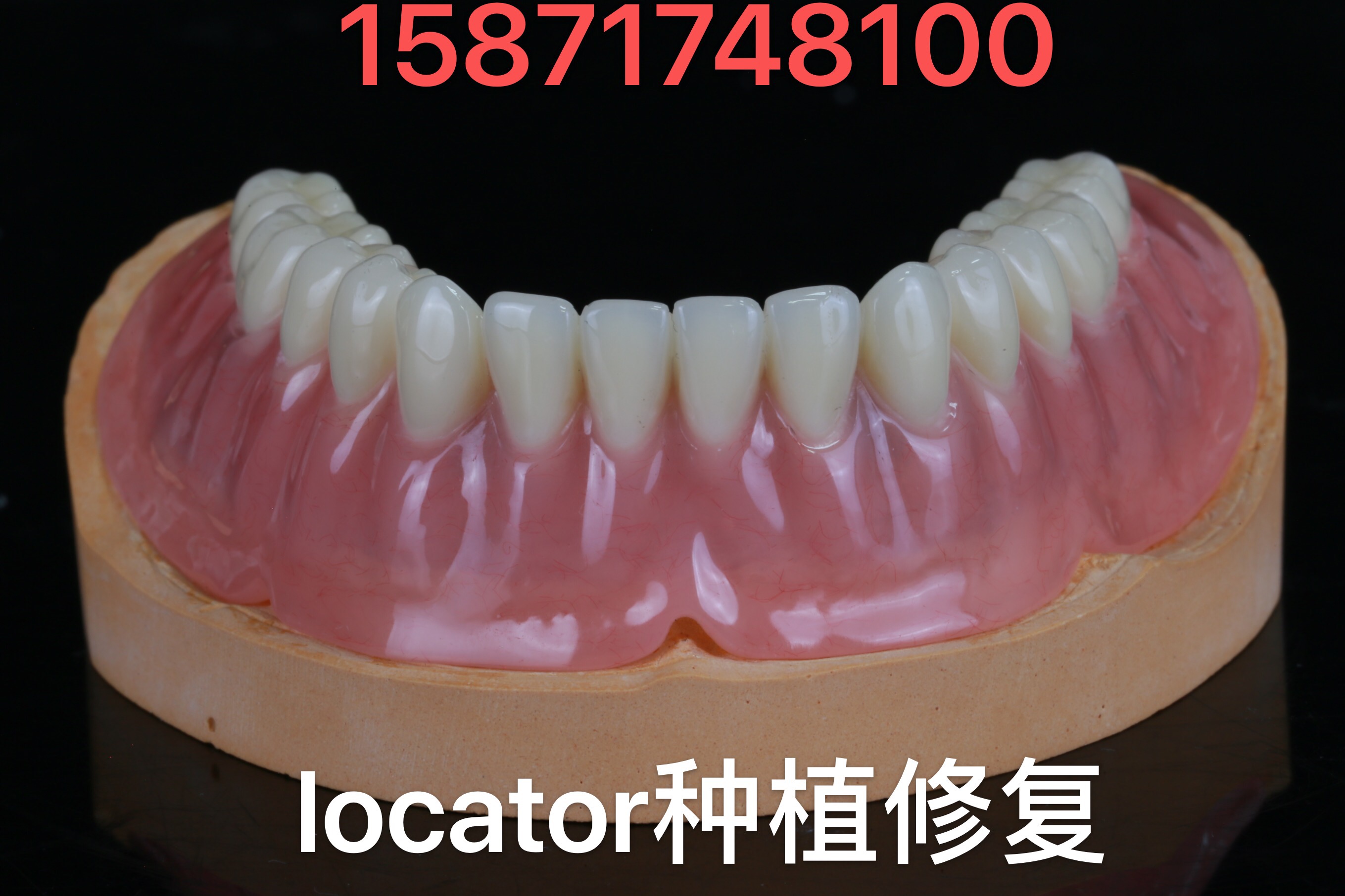 Coraterse Locator Right Angle Abutment All implant systems are complete with edentulous jaw implant restoration