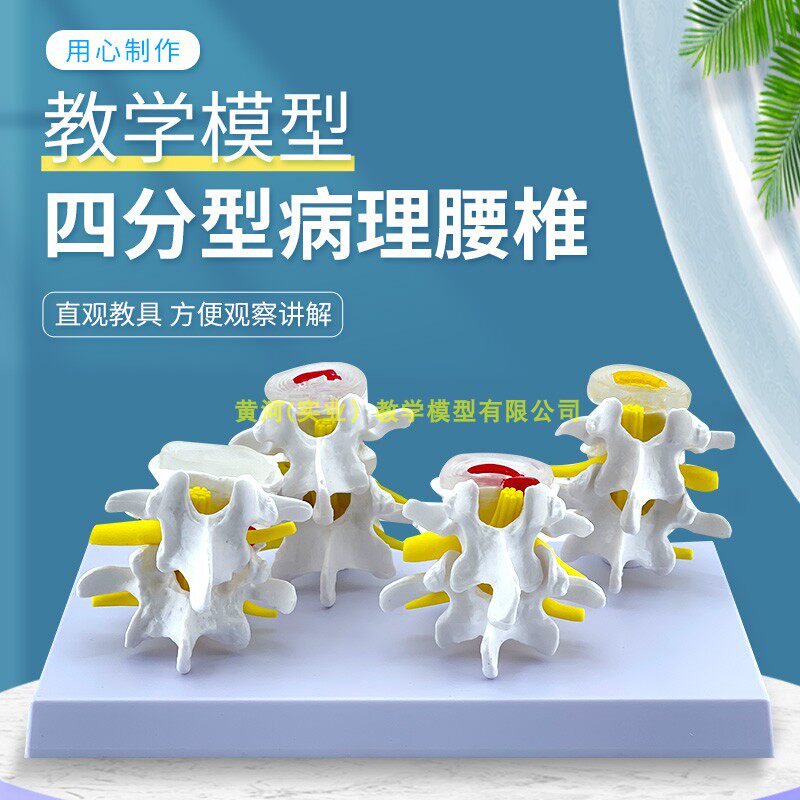 四阶段病理腰椎模型 腰间盘病变模型 椎间盘/病理模型 病变腰椎