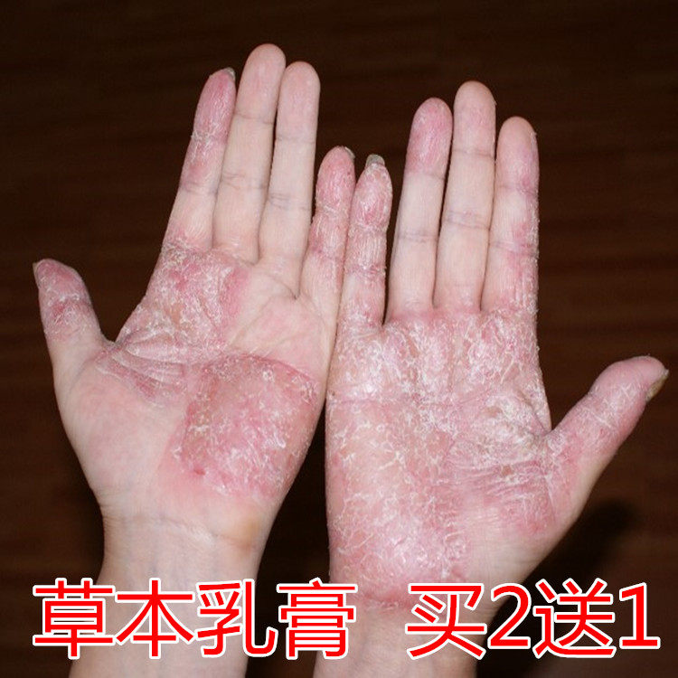 cream for peeling hands