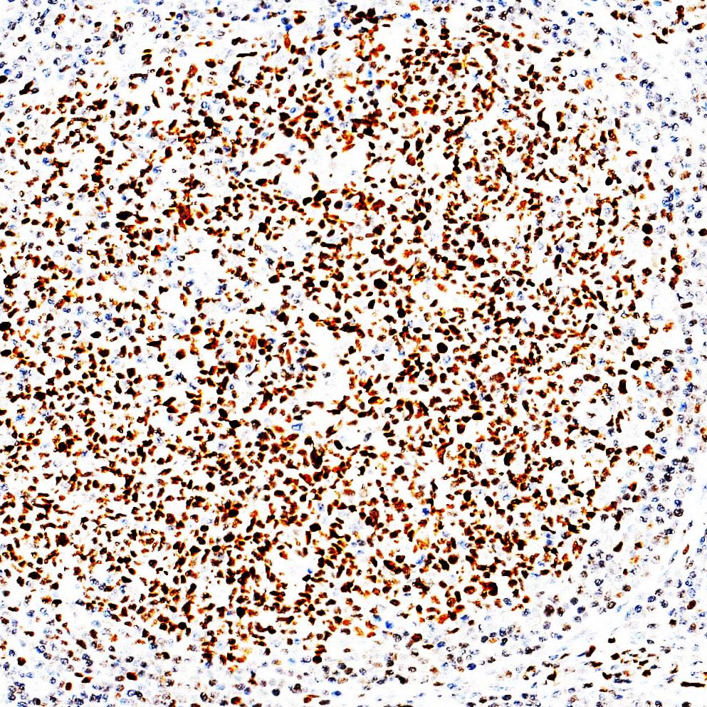 中杉金桥 ZM-0011 bcl-6抗体试剂（免疫组织化学）
