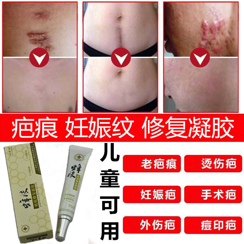 Kang Rui Balm Scar Artifact Propolis Scar Gel Fade Stretch Marks Knife Scar Smoke Scar Burn Scar Scratch